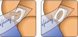 urinopsamling hos babyen ved urinal