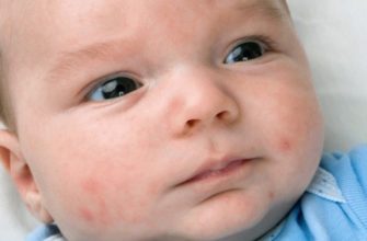 por que um recém-nascido tem acne no rosto