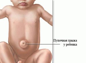 Kūdikių bambos išvaržos simptomai