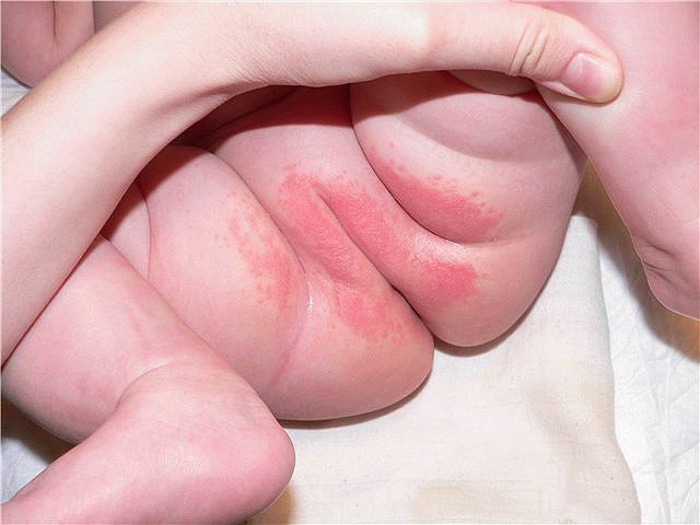 Cómo tratar la dermatitis del pañal en un recién nacido