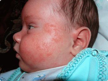 symptoms of diathesis in infants