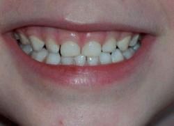 çocuk neden dişlerini taşlıyor