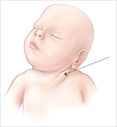 torticollis hos nyfødte