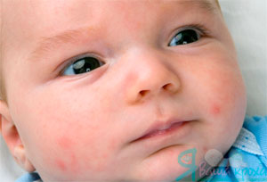 dziecko z objawami alergii pokarmowej