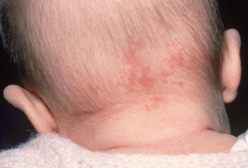 hæmangioma på bagsiden af ​​hovedet hos en nyfødt baby