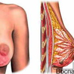 Symptomer på mastitis