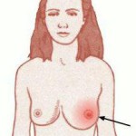 Symptomer på mastitis med gua
