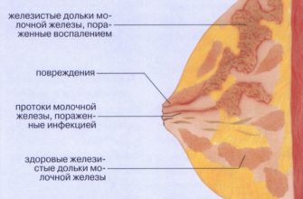 lactostàsia mamària