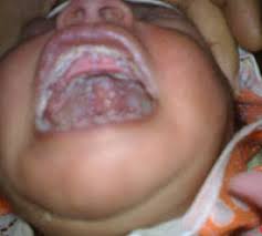 nó là một bệnh tưa miệng mạnh mẽ trong miệng của một đứa trẻ sơ sinh