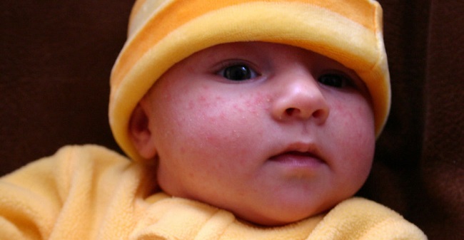 Myter om akne nyfödda