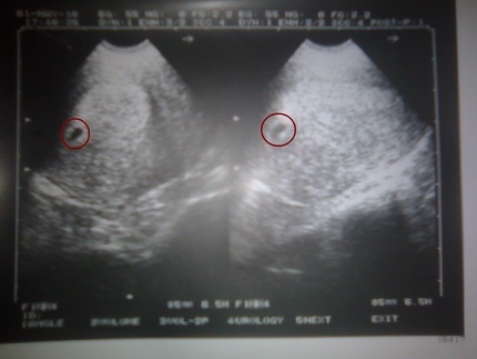 ultraljudsundersökning under den sjätte graviditeten
