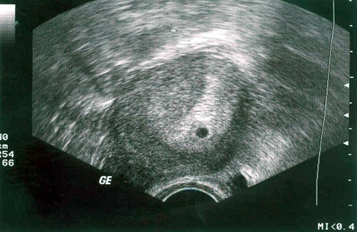 ultraljud under 2 veckors graviditet