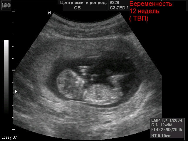 Ultralyd af fosteret efter 12 ugers drægtighed