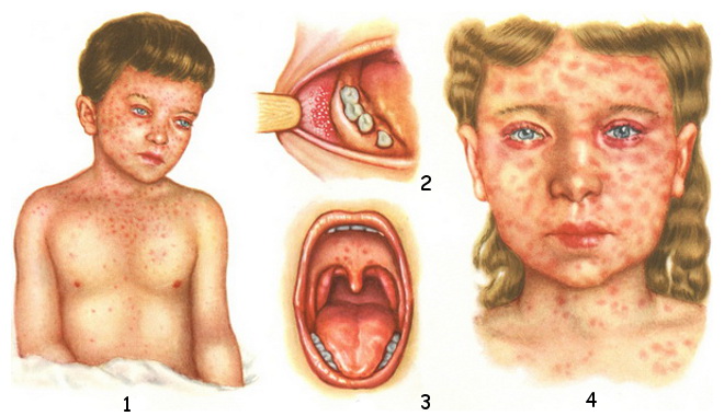 what does measles infection look like