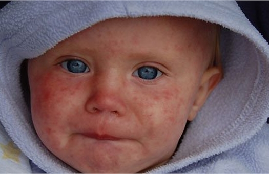 Η ιλαρά σε ένα παιδί