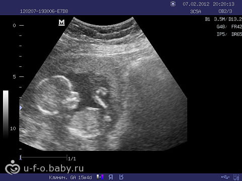 ultrason 15 hafta