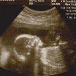 ultrasuoni 21 settimane