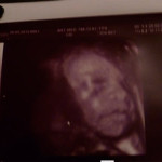 29 haftalık foto-ultrason