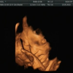 ultrazvuk-31-týden