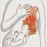 καούρα σε έγκυες γυναίκες