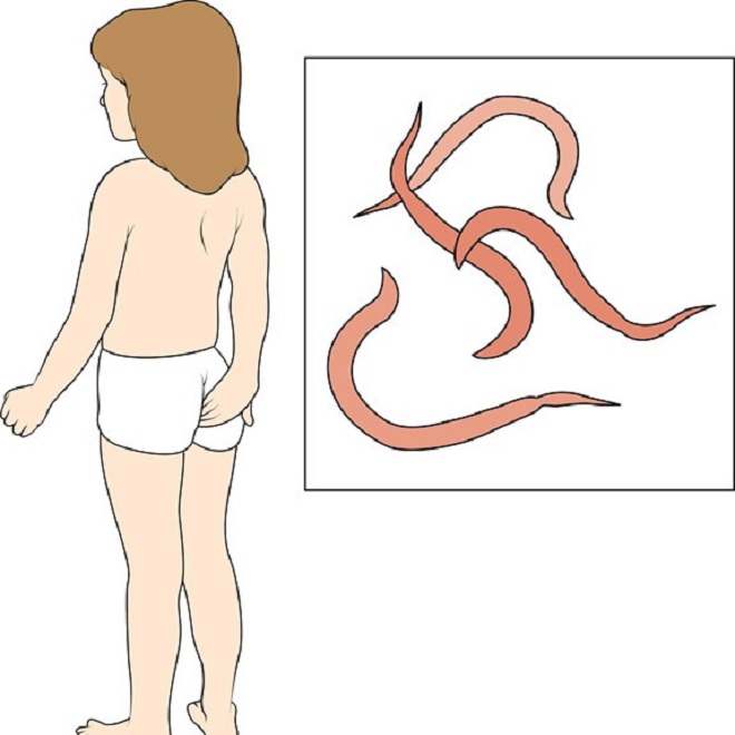 lombrices intestinales en un niño